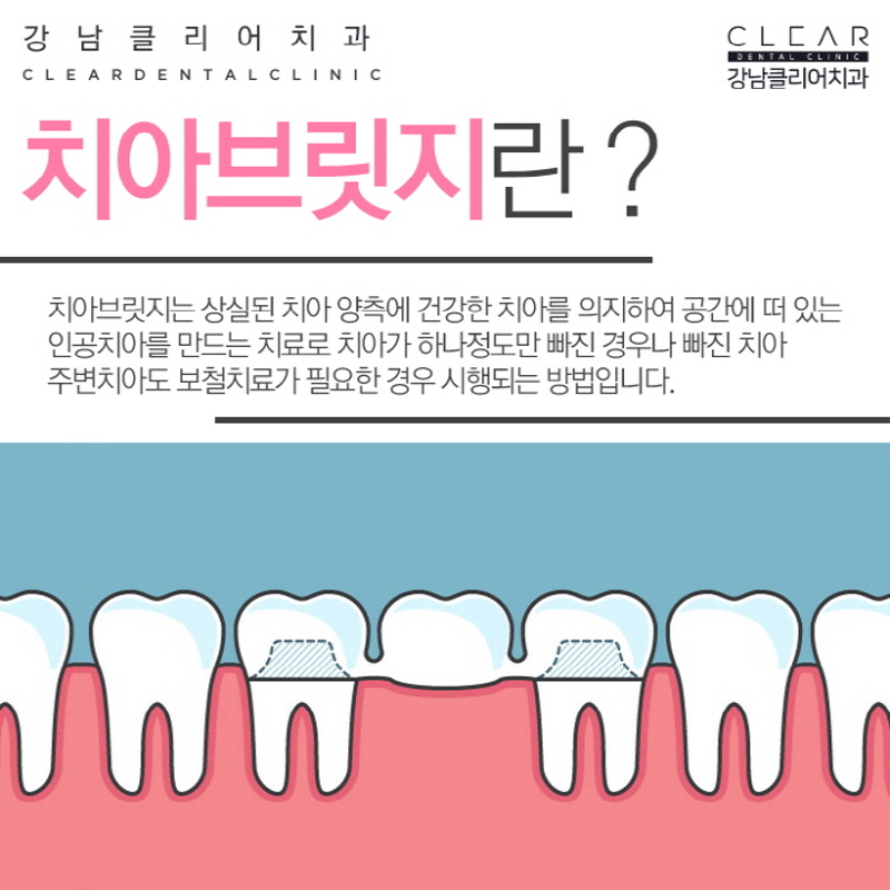 강남역보철치료 내가 가지고 있는 자연치아를 보호하기 관련 이미지 6