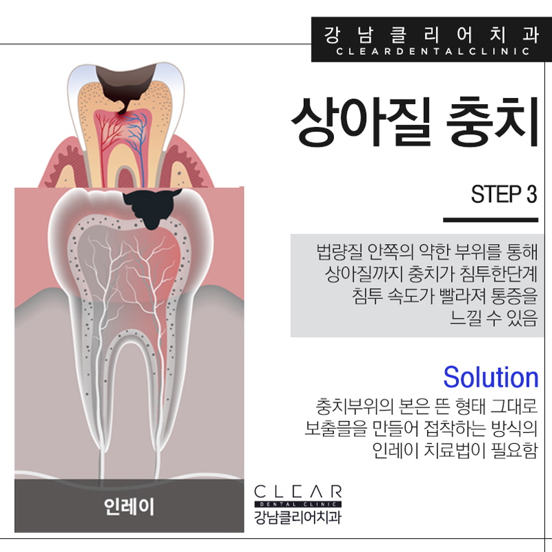 강남역충치치료 나에 충치 단계에 맞게 관련 이미지 5