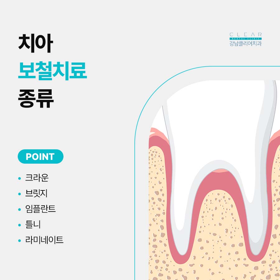치아보철치료 종류 단계에 따라 관련 이미지 3