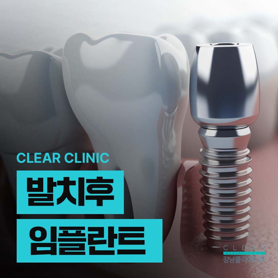 발치후 임플란트 가능한 조건은 무엇? 관련 이미지 1