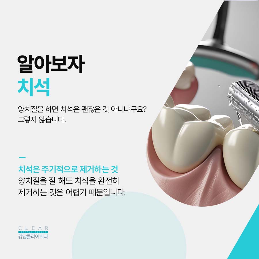 치아 스케일링 주기 치석관리를 위해서 관련 이미지 3
