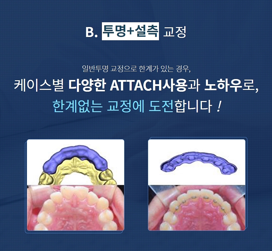 강남클리어치과 교정 종류가 궁금해 관련 이미지 4