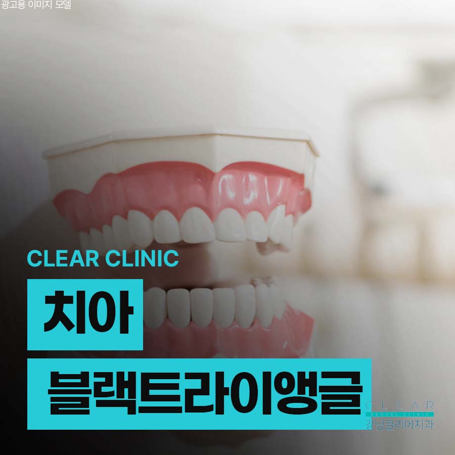 치아 블랙트라이앵글 원인 치료방법은? 관련 이미지 1