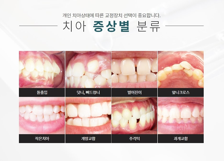 강남 치아교정 꼼꼼하게 알아봐야지 관련 이미지 5