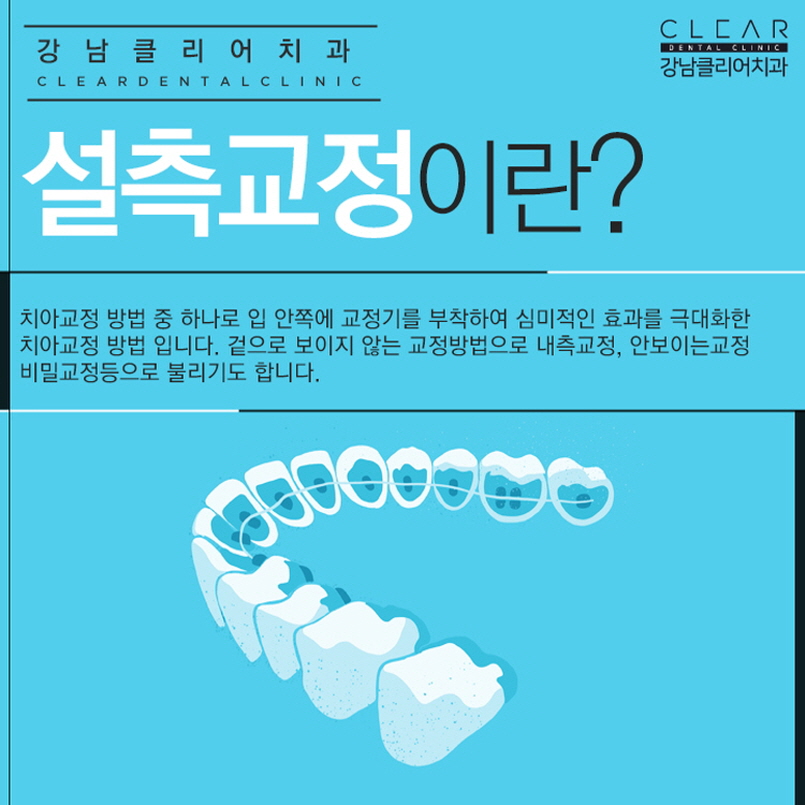 강남역치아교정치과 가지런한 치아 만드는 교정방법들 관련 이미지 6