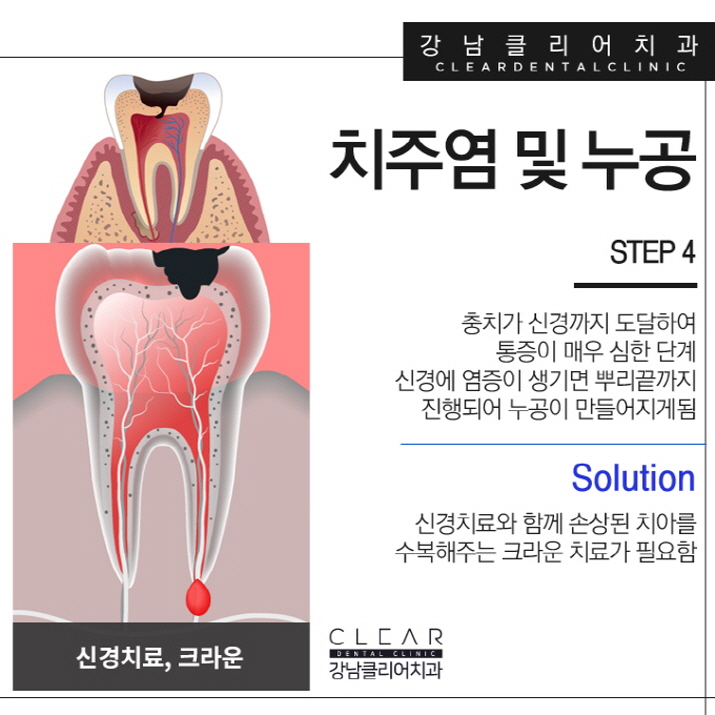 충치치료방법 단계별 필요한 보철치료까지 관련 이미지 8