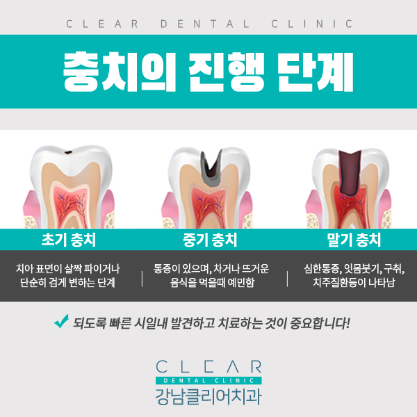 강남충치치료 레진,인레이 단계별 치료방법 관련 이미지 2