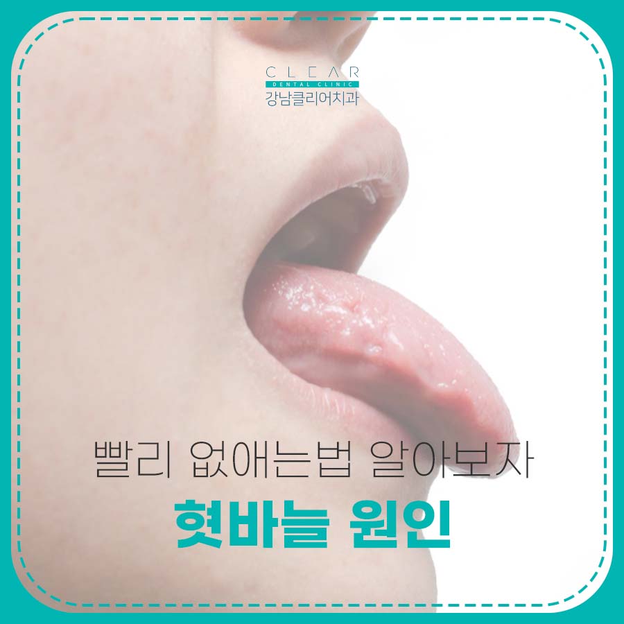 혓바늘 원인 빨리 없애는법 알아보자 관련 이미지 1