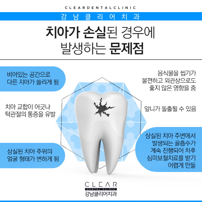 치아 보철치료 종류 심미보철 등 다양해 관련 이미지 3
