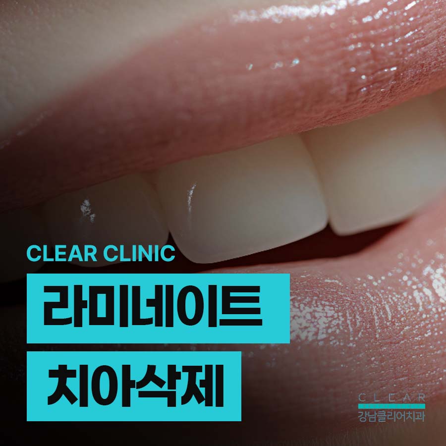 라미네이트 치아삭제 꼭 필요한 만큼만 해요 관련 이미지 1