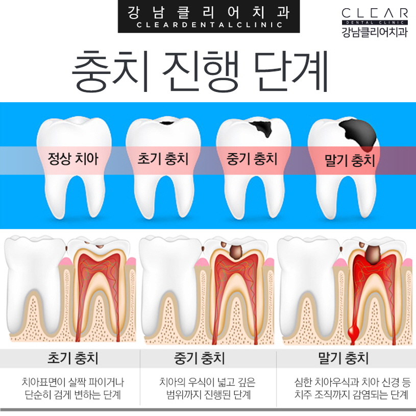 강남역충치치료 늦어지면 발치까지 필요해 관련 이미지 3