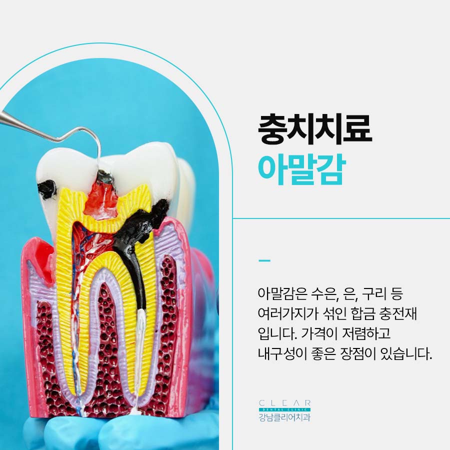충치치료 레진 아말감 차이 비교점 관련 이미지 4