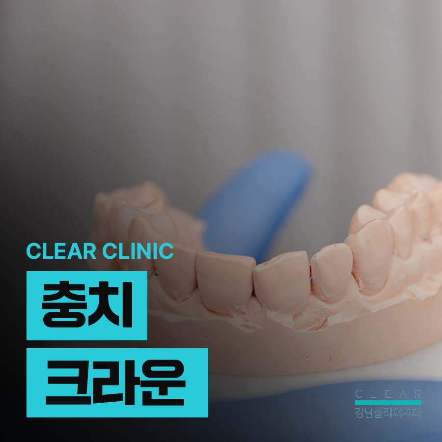 충치 크라운 수명 오래 사용하려면 관련 이미지 1