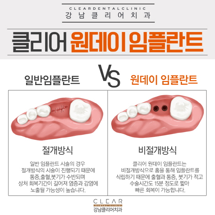 강남역 원데이임플란트 당일임플란트 자연스럽고 안전하게 관련 이미지 4