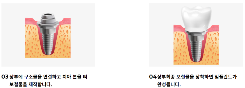 강남임플란트잘하는치과 내 구강 구조에 맞게! 관련 이미지 6