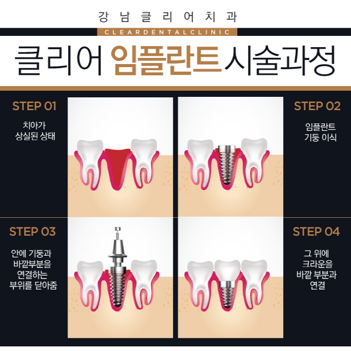 강남역임플란트치과 선택의 기준 관련 이미지 3