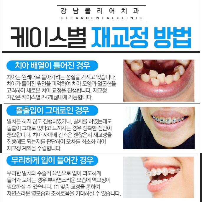 강남 치아재교정 치과 빠르고 확실하게 관련 이미지 7