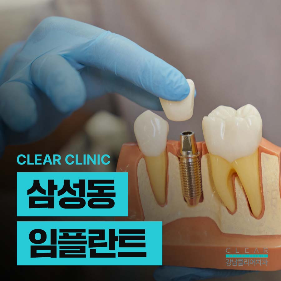 삼성동 임플란트 당일 식립이 가능한 경우는 관련 이미지 1