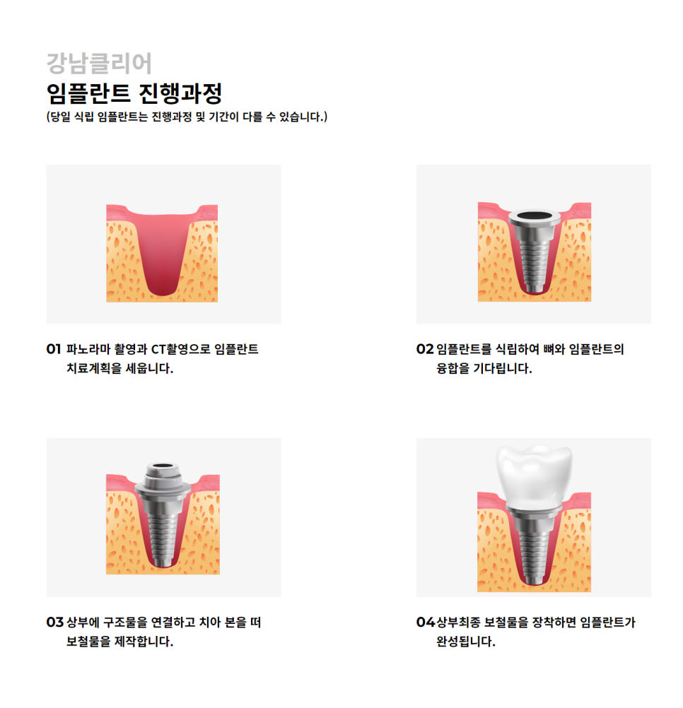 강남 임플란트치과 탄탄한 고정력과 편의성 관련 이미지 6
