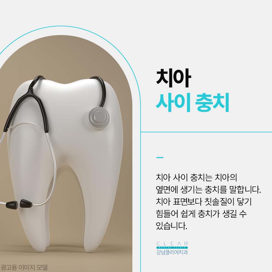 치아 사이 충치 원인 치료방법 정리해봐요 관련 이미지 2