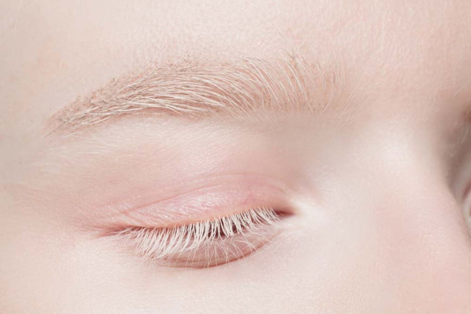 다래끼 나는 이유 전염여부 빨리 낫는법 관련 이미지 4