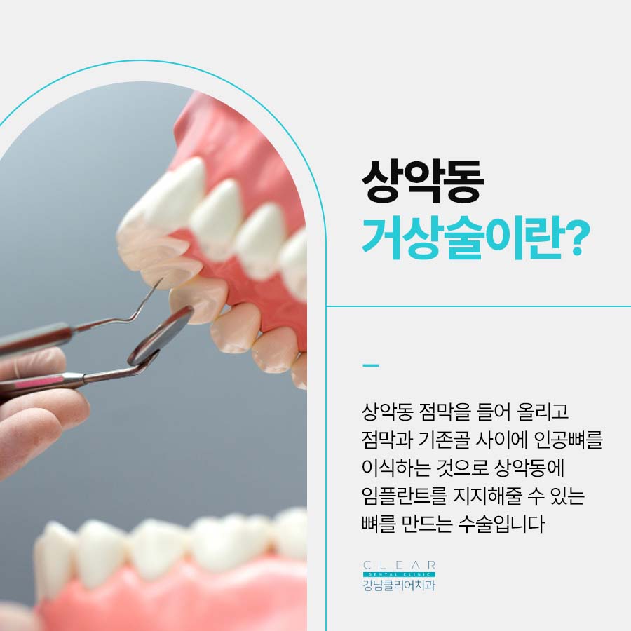 상악동거상술 주의사항 꼭 알아야 해요 관련 이미지 2