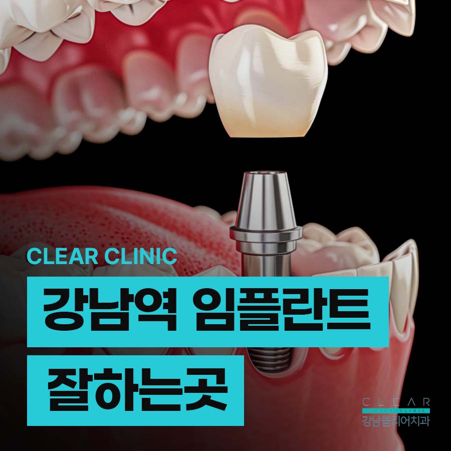 강남역 임플란트 잘하는곳 정품 재료를 사용하니까 관련 이미지 1
