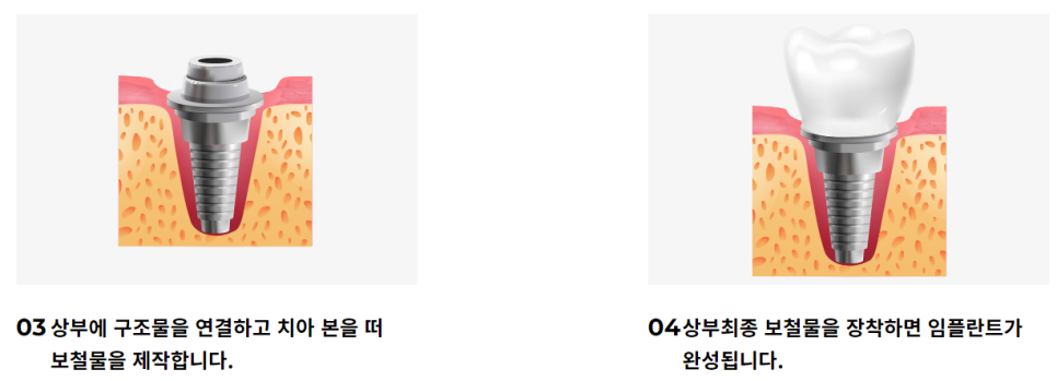 도곡동임플란트치과 불편함 없이 오래도록 사용 가능한 관련 이미지 6
