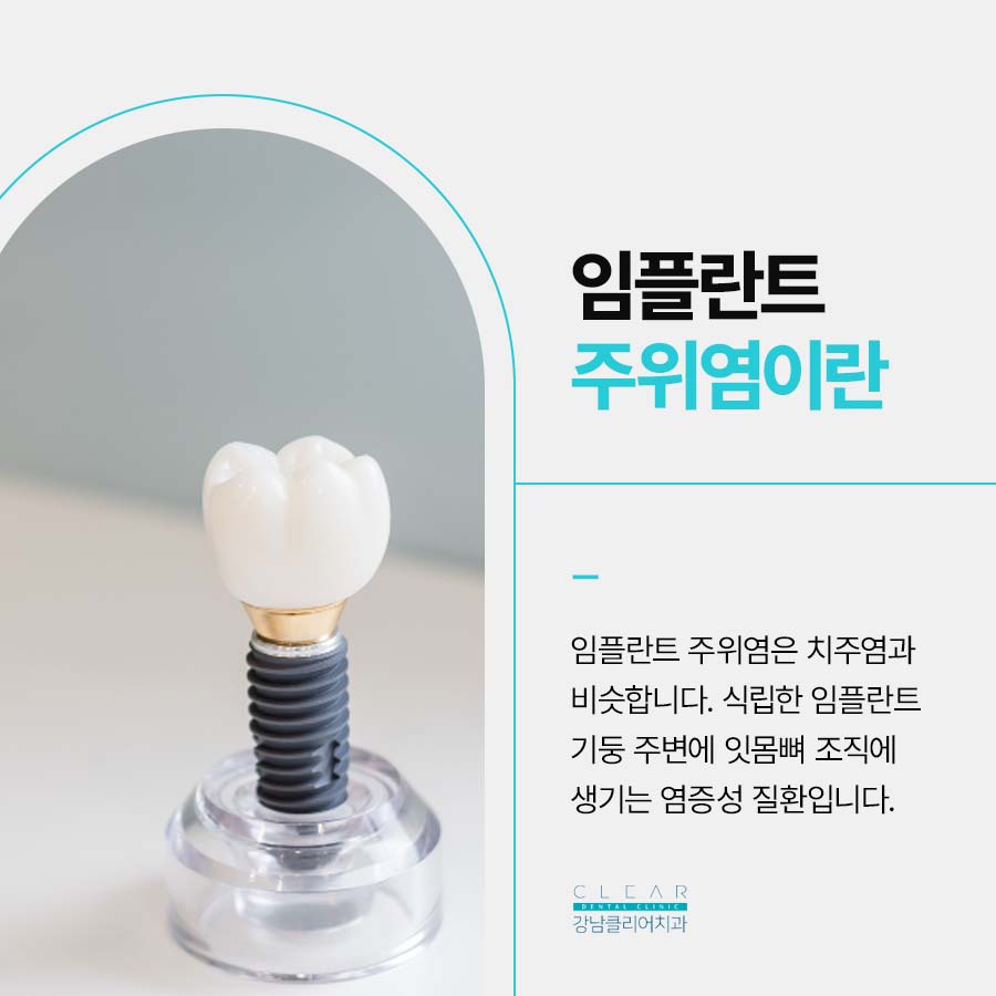 논현동 임플란트 주위염 증상 예방법 관련 이미지 3
