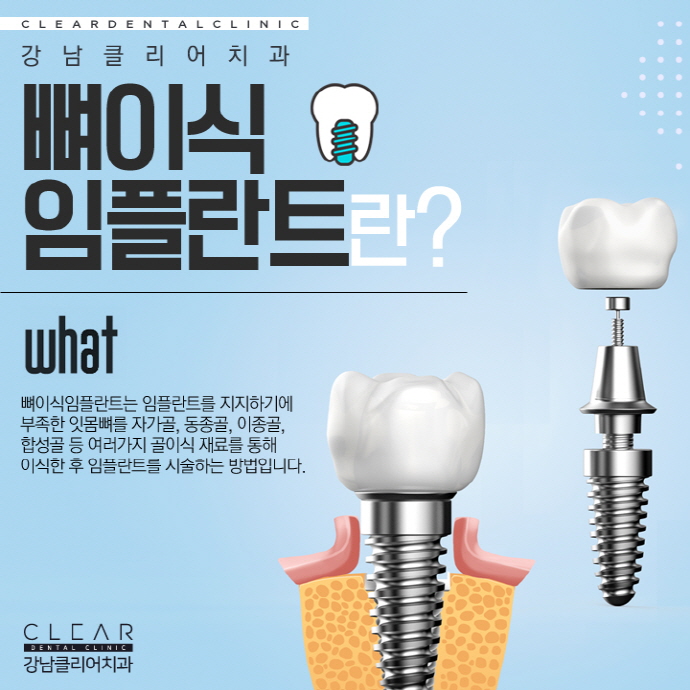뼈이식임플란트 무엇이며 뼈이식은 왜 중요할까? 관련 이미지 2
