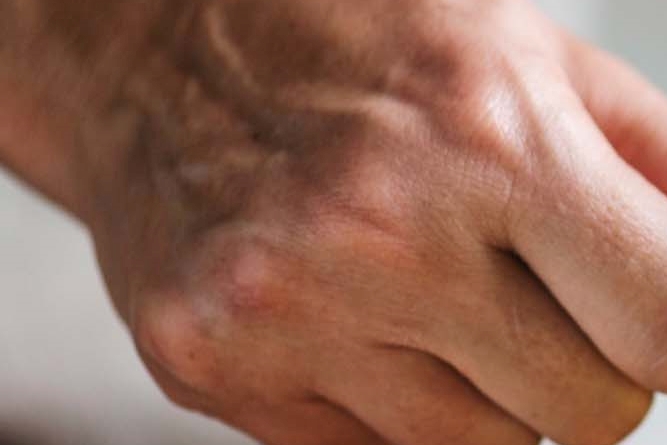 신경치료 후 크라운 꼭 해야되는 이유 관련 이미지 23