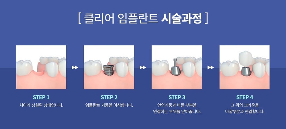 강남역 임플란트 한 번으로 기대해봐 관련 이미지 5