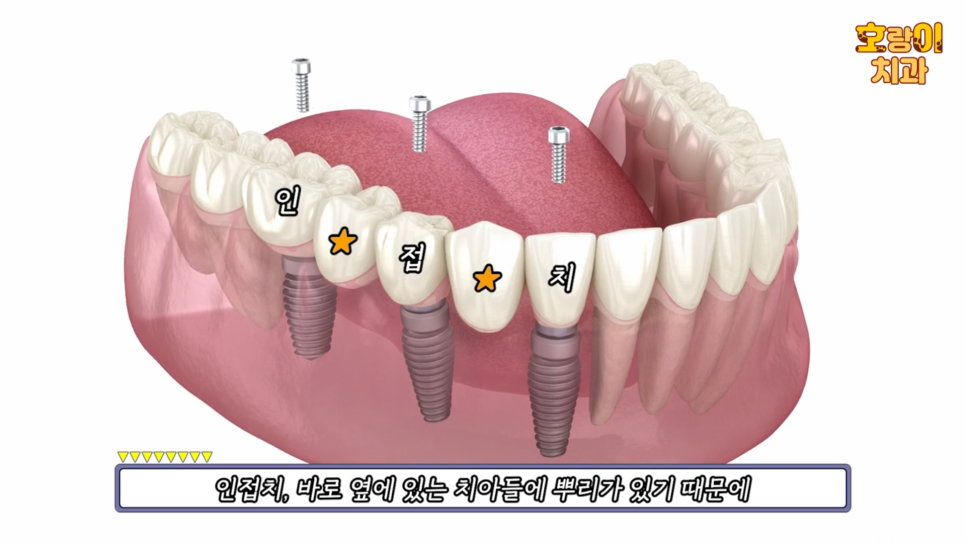 홍록기와 함께하는 임플란트 Q&A 관련 이미지 9