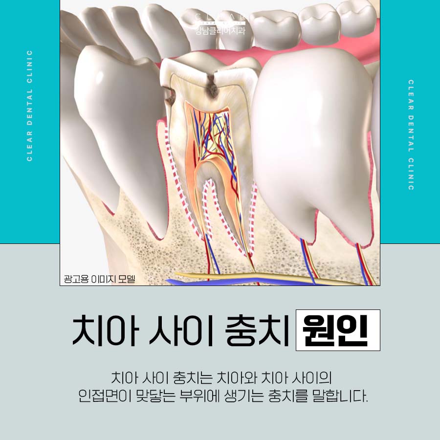 치아 사이 충치 보이지 않으니까 더 주의해야 관련 이미지 2