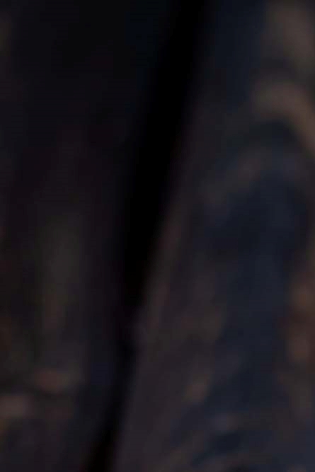 임플란트뼈이식수술 뼈이식 종류 주의사항은? 관련 이미지 20