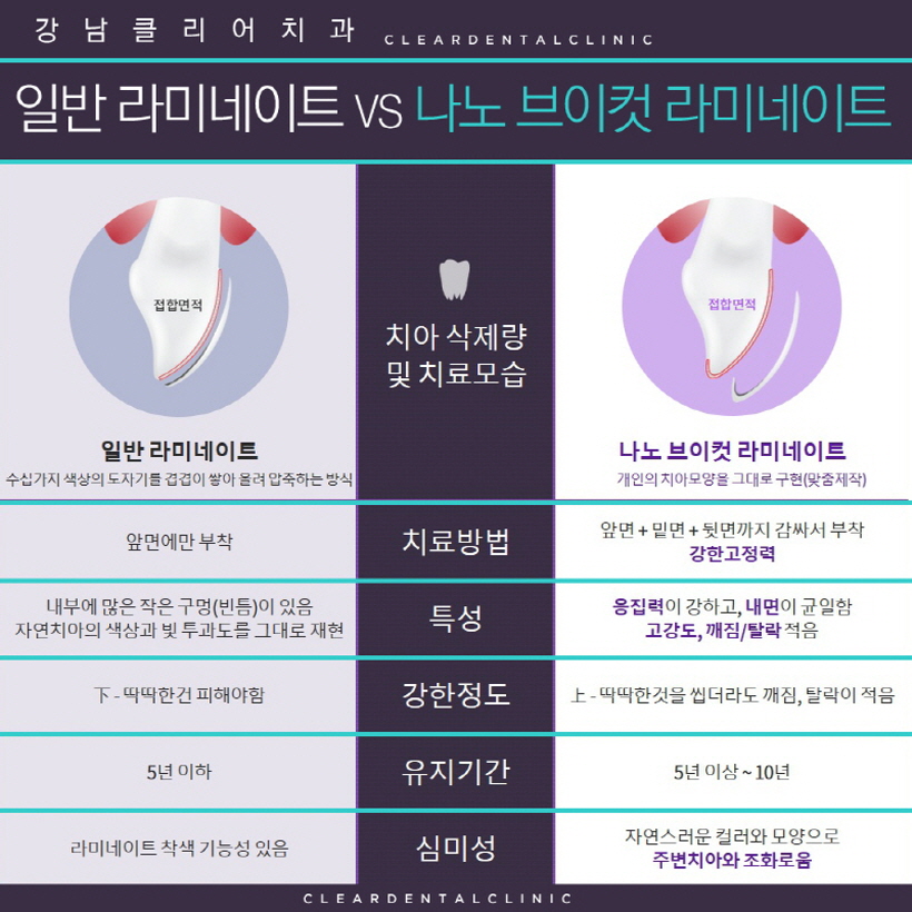 강남 치아라미네이트 개인의 치아모양 그대로 관련 이미지 5