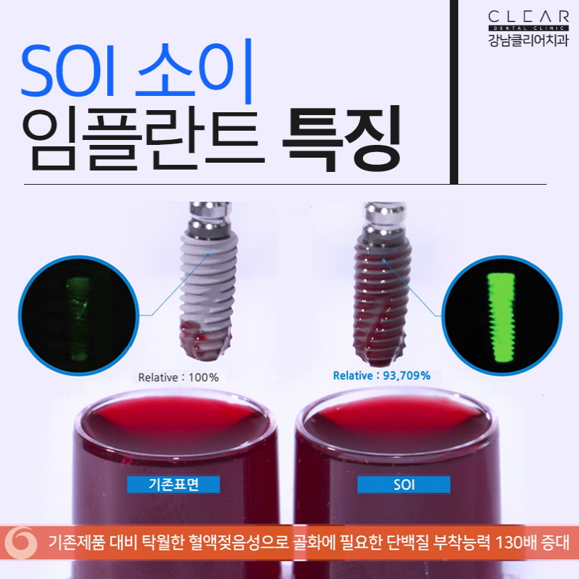 오스템임플란트 SOI임플란트 무엇이 다를까요? 관련 이미지 5