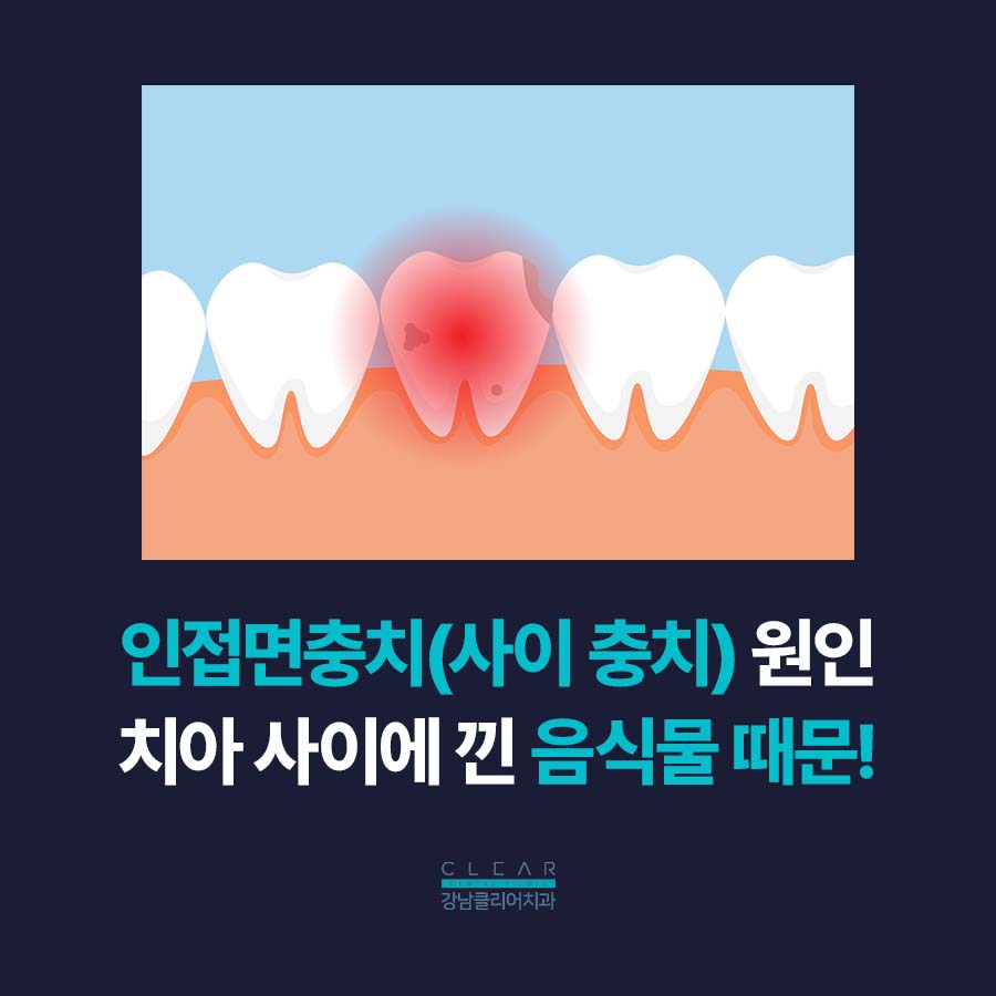 어금니 인접면충치 인레이 치료 적합한 이유 관련 이미지 2