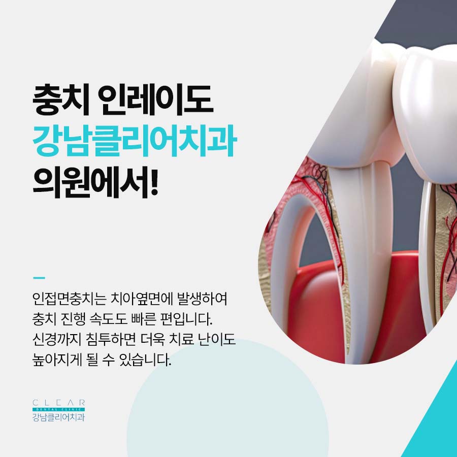 어금니 인접면충치 인레이 치료 적합한 이유 관련 이미지 4