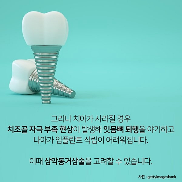 잇몸뼈가 부족해 임플란트 수술 어렵다면? 관련 이미지 6