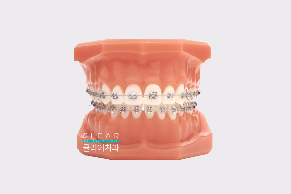 치아 교정 종류 및 교정 방법 관련 이미지 2