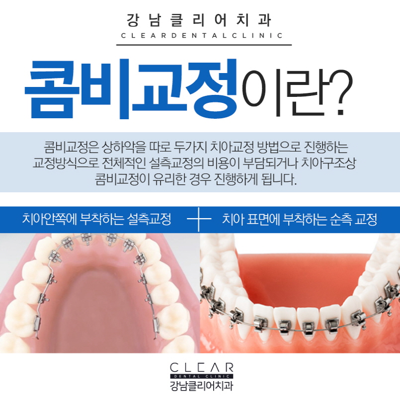 설측교정 교정한거 아무도 몰라요 관련 이미지 3