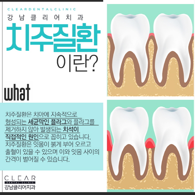 강남역스케일링 건강한 치아와 잇몸건강을 위해 관련 이미지 5