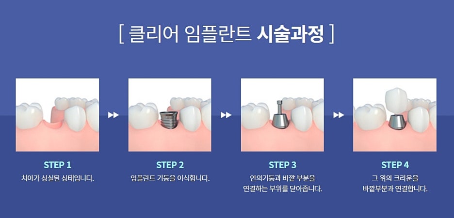 강남 임플란트치과 파악에 신경써야 관련 이미지 4