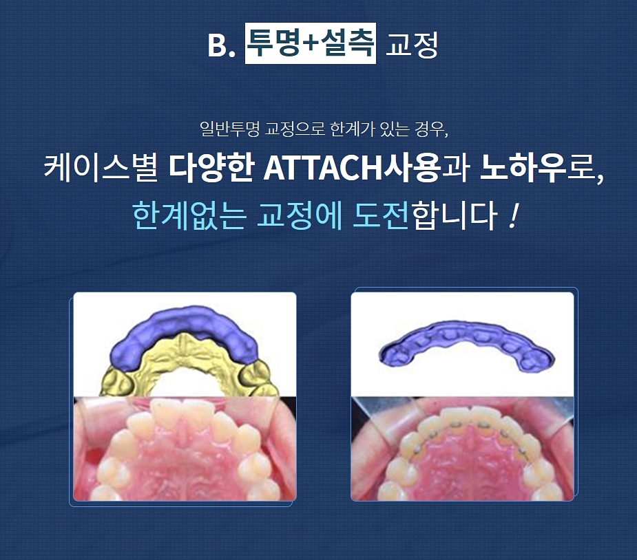 강남클리어치과 교정중점 여기와 함께라면? 관련 이미지 5