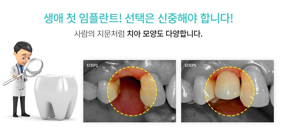 임플란트 환자중심 남다르고 싶어 관련 이미지 5