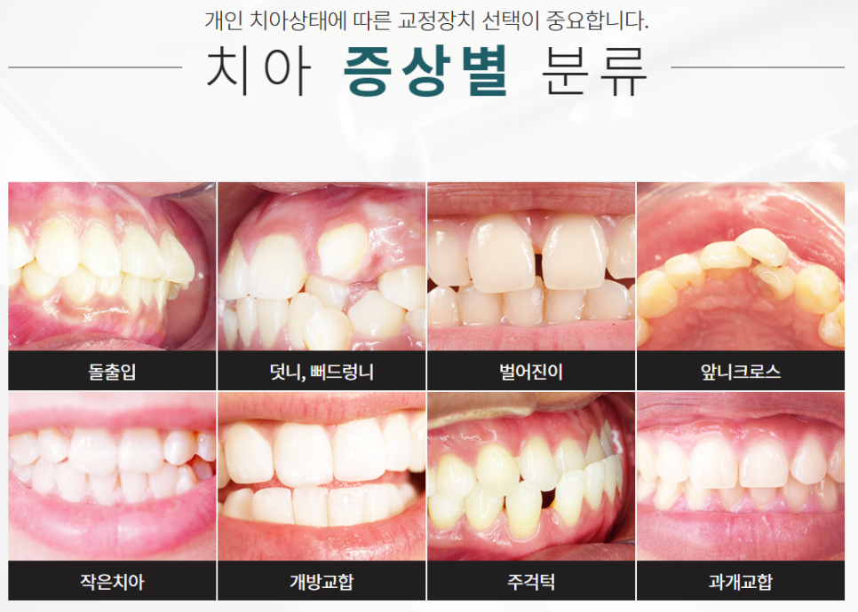 강남치아교정 기간 단축으로 불편함 적게 관련 이미지 4