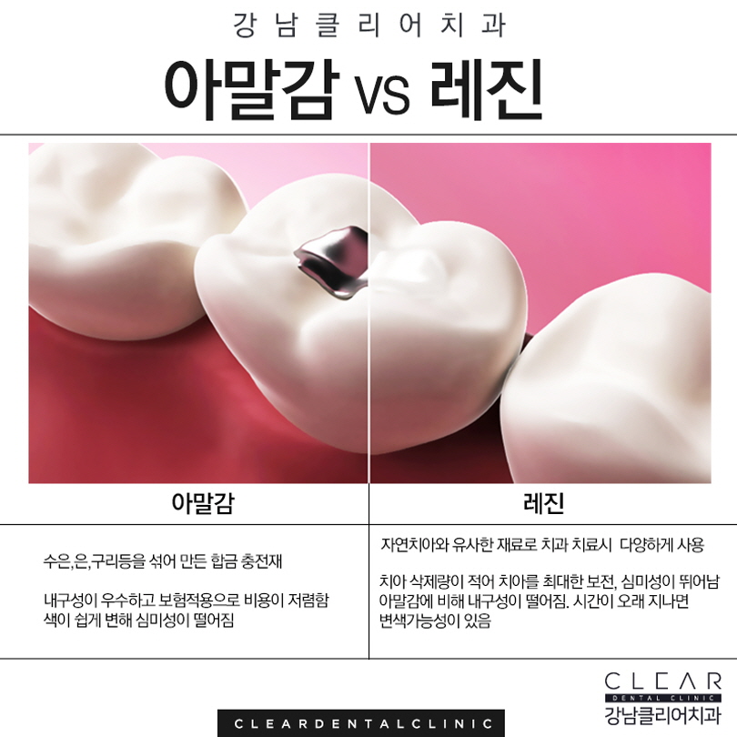 강남역충치치료 걱정보단 빠른 치료가 중요 관련 이미지 4