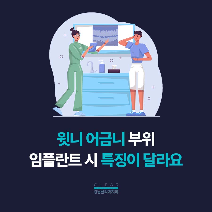 강남역 임플란트치과 앞니 어금니 부위에 따라 달라 관련 이미지 2