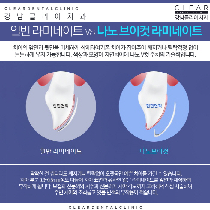 강남역라미네이트 잘하는곳 맞춤 제작 나노V컷 라미네이트 관련 이미지 5